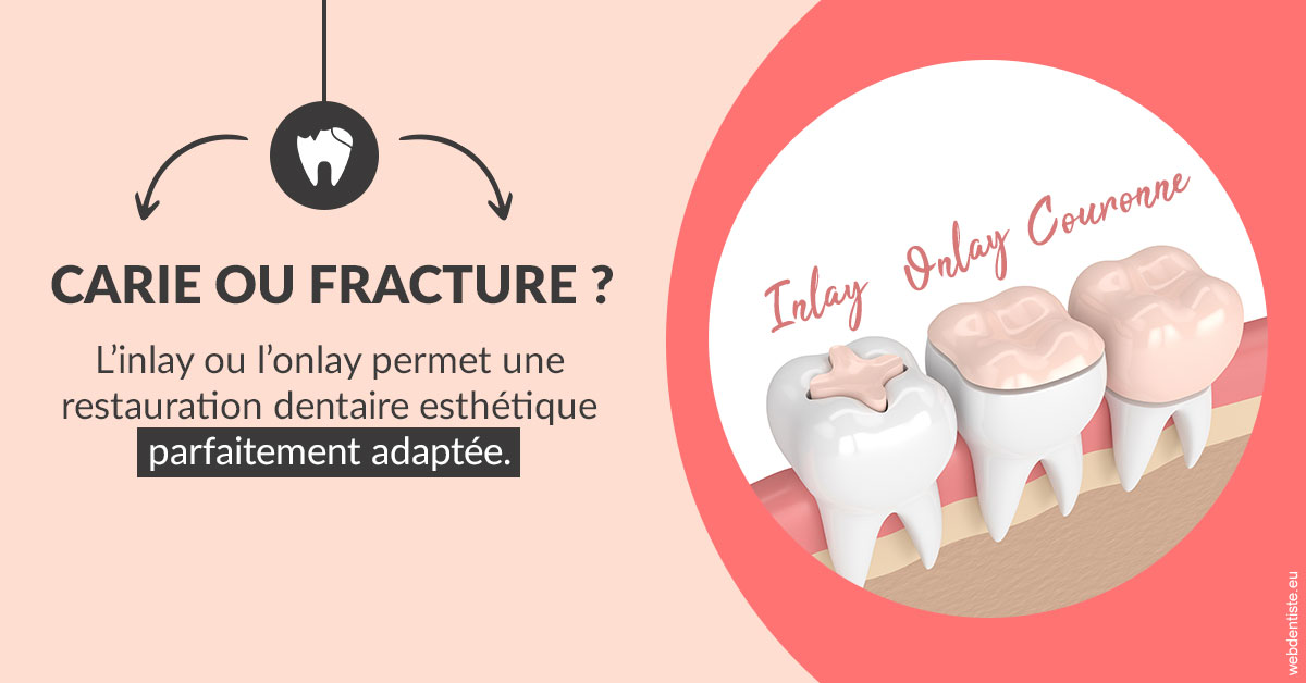 https://selarl-cabinet-dentaire-victor-hugo.chirurgiens-dentistes.fr/T2 2023 - Carie ou fracture 2