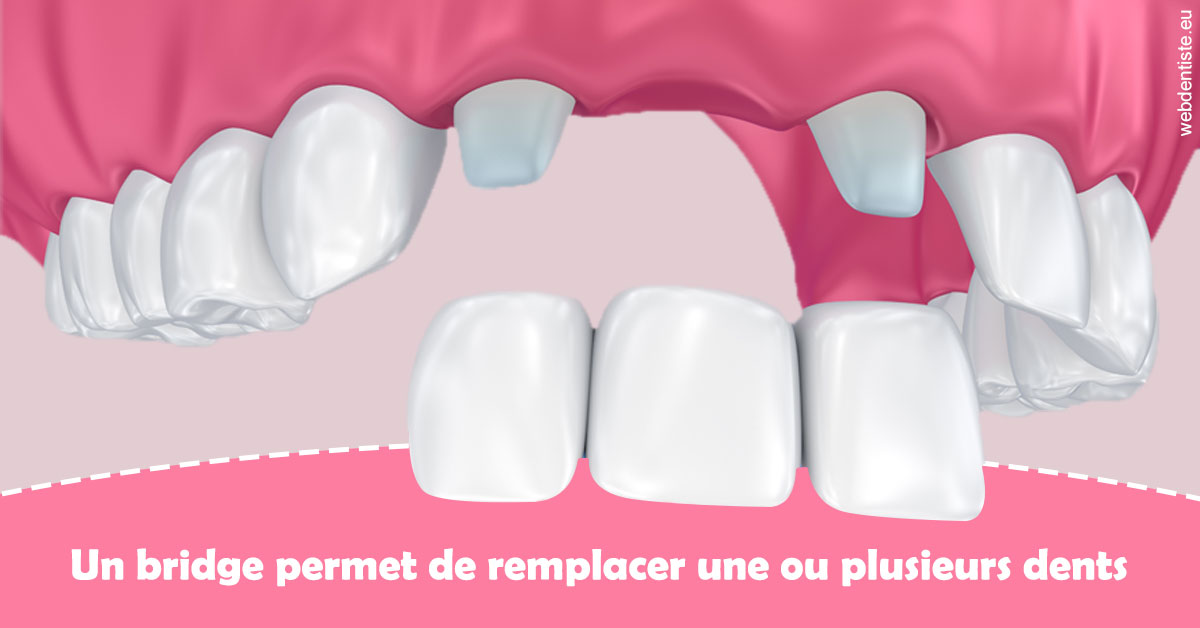 https://selarl-cabinet-dentaire-victor-hugo.chirurgiens-dentistes.fr/Bridge remplacer dents 2