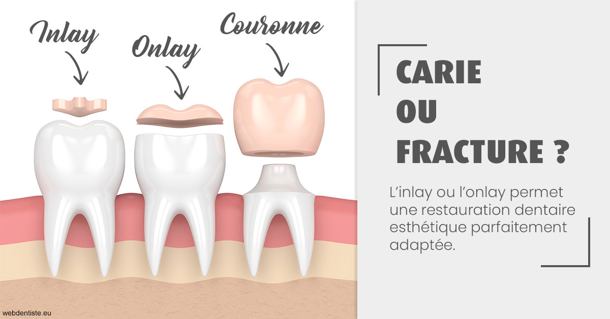 https://selarl-cabinet-dentaire-victor-hugo.chirurgiens-dentistes.fr/T2 2023 - Carie ou fracture 1