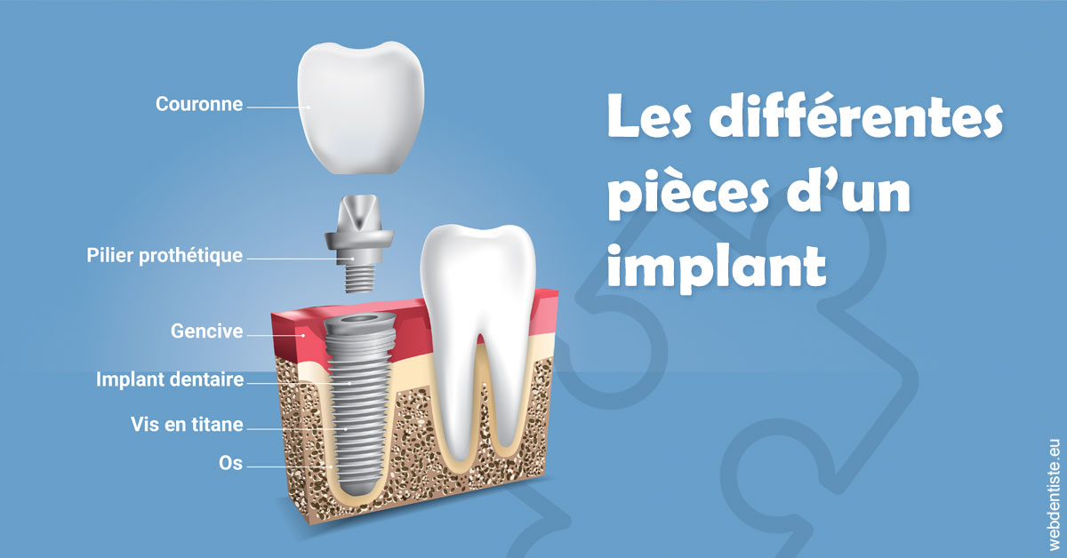 https://selarl-cabinet-dentaire-victor-hugo.chirurgiens-dentistes.fr/Les différentes pièces d’un implant 1