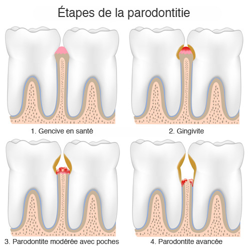 parodontite_etapes