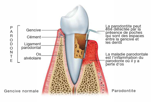parodontite_illustration